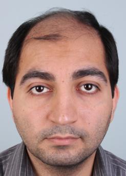 Before Hair Transplant&nbsp;Front